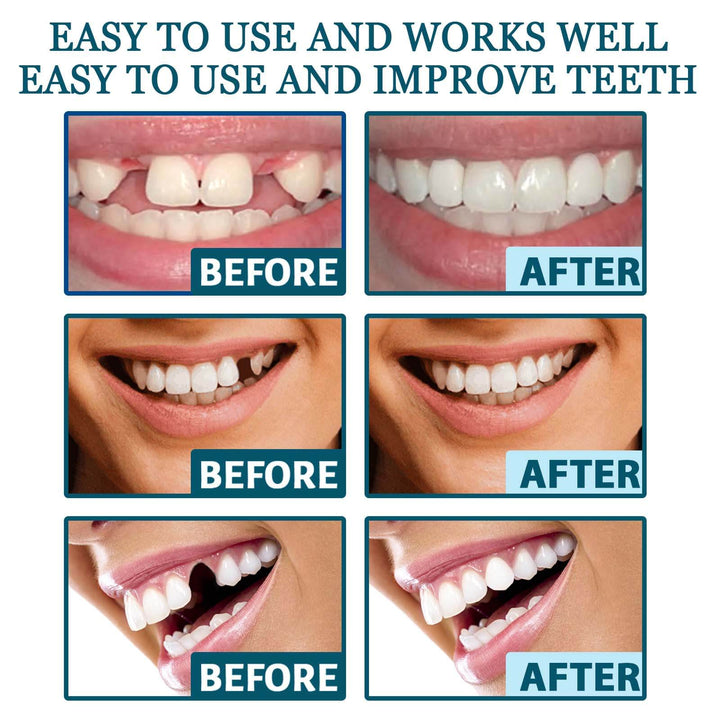  EELHOE Snap-on Dental Prosthetics for Gap Filling EELHOE Customizable Snap-on Dental Prosthetics Temporary Adhesive Gap Filling Tooth Correction Denture Set