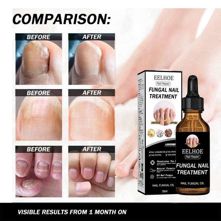 Eelhoe Fungal Nail Treatment before and after comparison with visible results from one month on. EELHOE Nail Restoration for Healthy, Shiny Nails EELHOE Nail Restoration Solution Enhances the Thickness and Shine of Nails While Aiding in the Removal of Nail Fungus and Dead Skin, Providing Nourishing Hydration for Nail Care