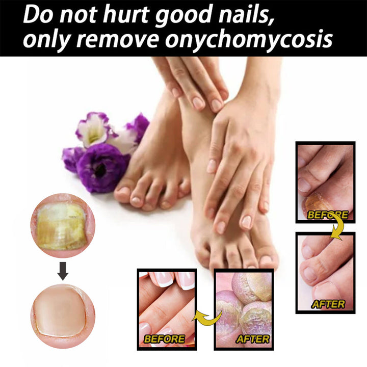 Advertisement showing before and after effects of treating onychomycosis with a product, featuring a person's feet and hands. EELHOE Nail Restoration for Healthy, Shiny Nails EELHOE Nail Restoration Solution Enhances the Thickness and Shine of Nails While Aiding in the Removal of Nail Fungus and Dead Skin, Providing Nourishing Hydration for Nail Care