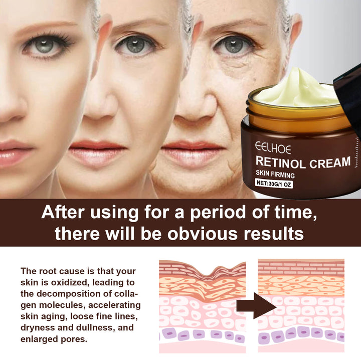 Advertisement for Eelhoe Retinol Cream showing before and after effects on skin. EELHOE Retinol Cream: Hydrating Anti-Aging Solution EELHOE Retinol Cream Age-Defying Tightening Illuminating Hydrating Face Skincare Cream