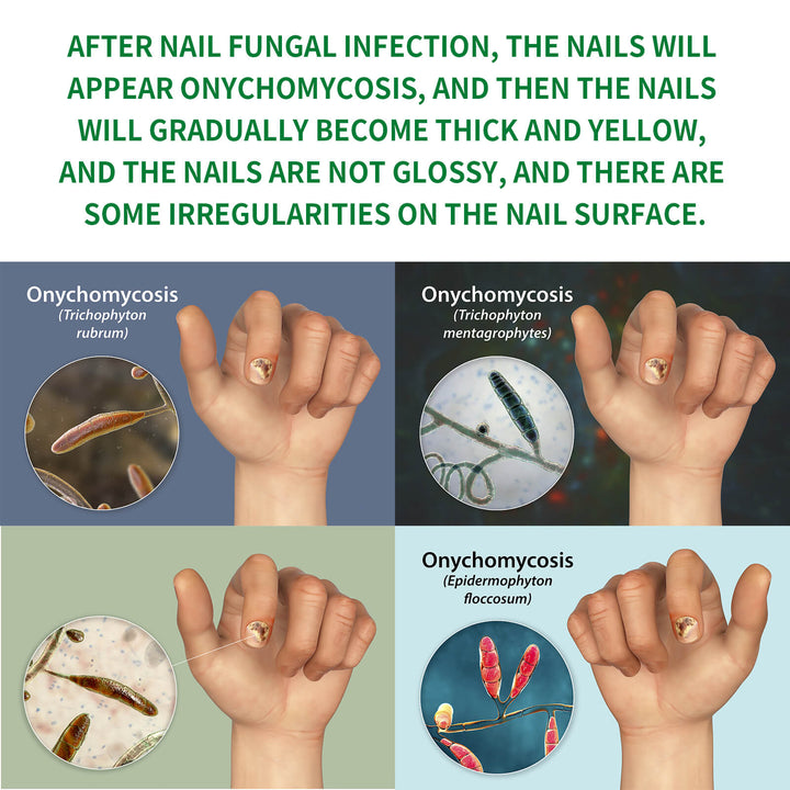 Illustration of onychomycosis with nail images and fungal spores. Jaysuing Ginger Nail Treatment for Healthy Nails Jaysuing Ginger Nail Treatment for Hands and Feet Soft Nail Polish Hydrating Solution for Fungal Nail Infection