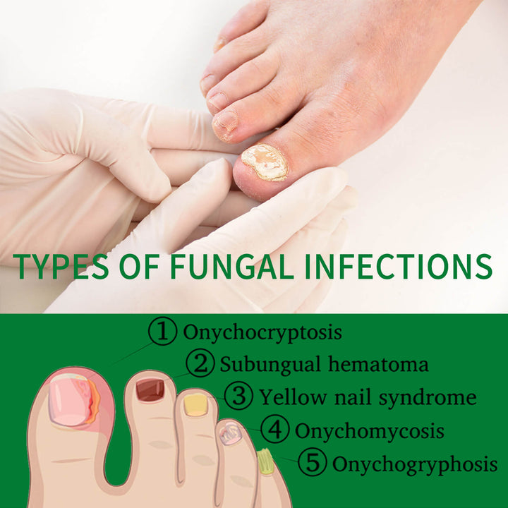 Foot with fungal infection symptoms and gloved hand, text on types of fungal infections. Jaysuing Ginger Nail Treatment for Healthy Nails Jaysuing Ginger Nail Treatment for Hands and Feet Soft Nail Polish Hydrating Solution for Fungal Nail Infection