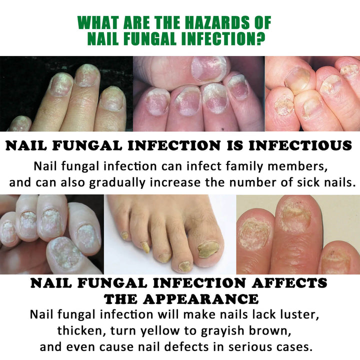 Informational graphic about nail fungal infection with images of affected nails. Jaysuing Ginger Nail Treatment for Healthy Nails Jaysuing Ginger Nail Treatment for Hands and Feet Soft Nail Polish Hydrating Solution for Fungal Nail Infection