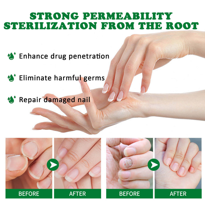Hand care product advertisement with before and after effects on nails. Jaysuing Ginger Nail Treatment for Healthy Nails Jaysuing Ginger Nail Treatment for Hands and Feet Soft Nail Polish Hydrating Solution for Fungal Nail Infection