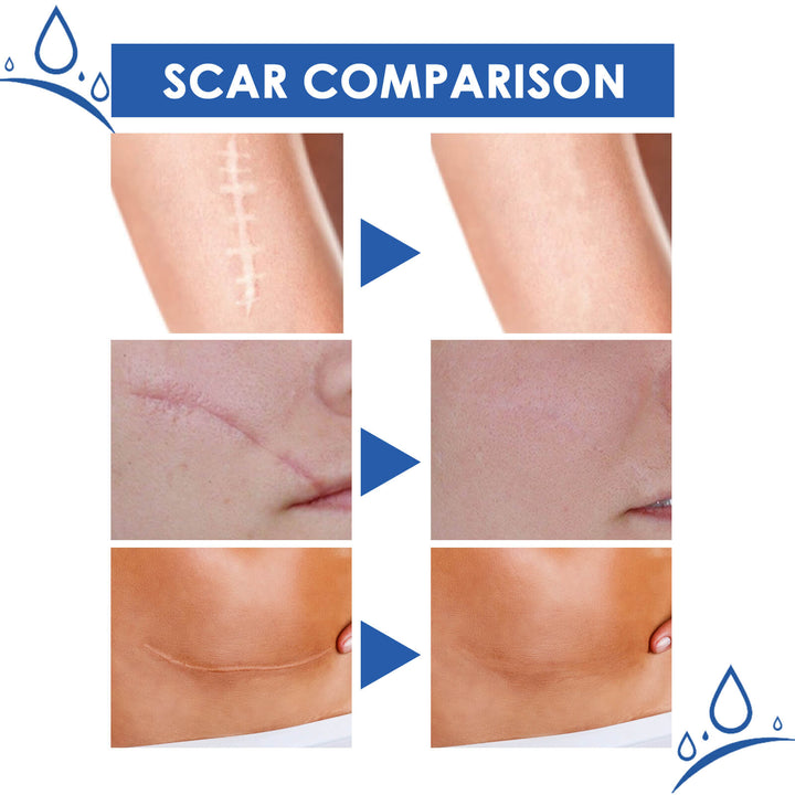 Scar comparison before and after treatment with blue arrows and 'SCAR COMPARISON' text. Jaysuing Scar Cream: Lighten, Smooth, and Firm Skin Jaysuing Scar Cream Cream that Lightens Scars Smoothens Skin firms It Up and Aids In Skin Repair